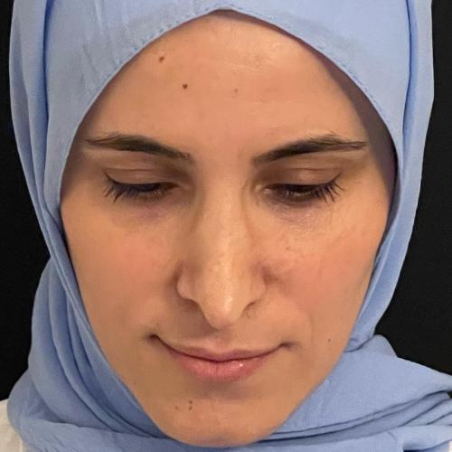 Septorrinoplastia Foto antes/después